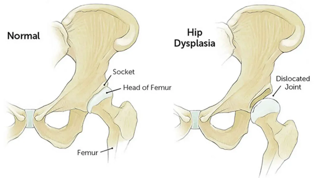 Image of normal hip joint vs one with hip dysplasia
